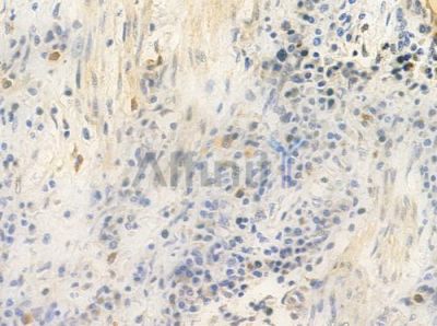 TFE3 Antibody - AF0363 at 1/100 staining human colon carcinoma by IHC-P.