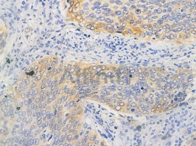 MEF2C Antibody - AF0433 at 1/100 staining human pancreatic carcinoma by IHC-P.