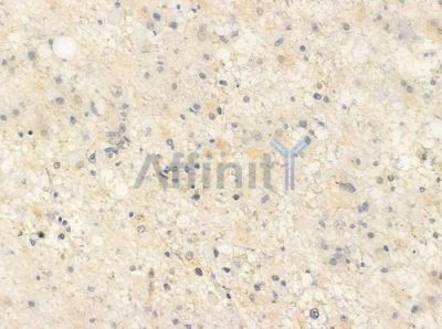 ECRG4 Antibody - AF0475 at 1/100 staining human astrocytoma by IHC-P.