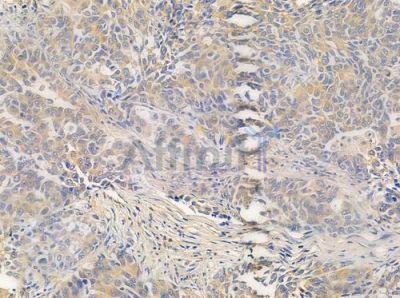 LRAT Antibody - AF0486 at 1/100 staining human lung squamous cell carcinoma by IHC-P.