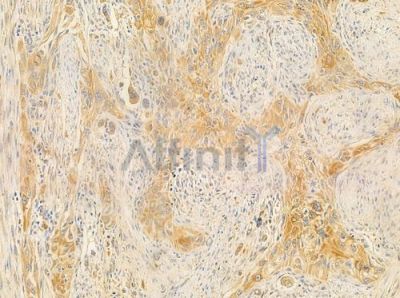 LRAT Antibody - AF0486 at 1/100 staining human tongue carcinoma by IHC-P.