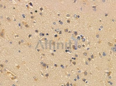 THR beta Antibody - AF0487 at 1/100 staining human glioblastoma by IHC-P.