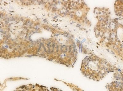 XRN2 Antibody - AF0490 at 1/100 staining human ovarian carcinoma by IHC-P.
