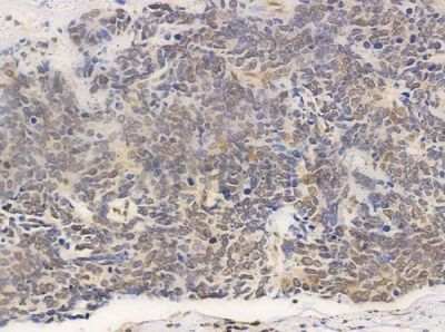 XRN2 Antibody - AF0490 at 1/100 staining human small cell lung carcinoma by IHC-P.