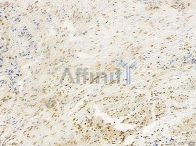 XRN2 Antibody - AF0490 at 1/100 staining human prostate carcinoma by IHC-P.