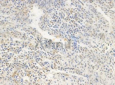 XRN2 Antibody - AF0490 at 1/100 staining human colon carcinoma by IHC-P.