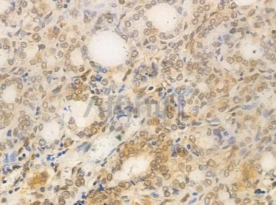 XRN2 Antibody - AF0490 at 1/100 staining human thyroid carcinoma by IHC-P.