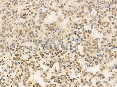 XRN2 Antibody - AF0490 at 1/100 staining human Hodgkin lymphoma by IHC-P.