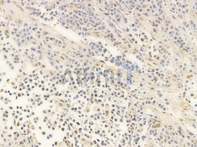 XRN2 Antibody - AF0490 at 1/100 staining human non-Hodgkin lymphoma by IHC-P.