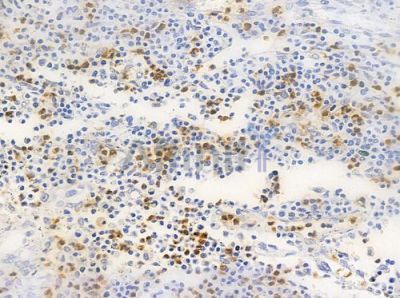 NT5C3 Antibody - AF0491 at 1/100 staining human colon carcinoma by IHC-P.