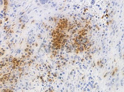NT5C3 Antibody - AF0491 at 1/100 staining human colon carcinoma by IHC-P.