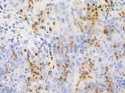 NT5C3 Antibody - AF0491 at 1/100 staining human esophageal carcinoma by IHC-P.