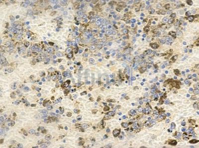 LASS4 Antibody - AF0499 at 1/100 staining human melanoma by IHC-P.