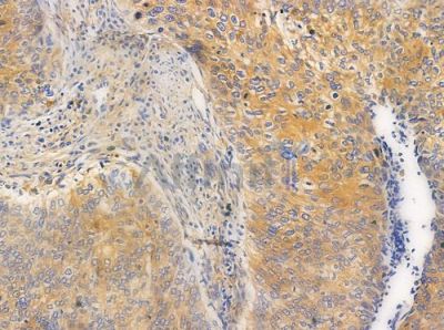 SKP2/p45 Antibody - AF0505 at 1/100 staining human cervical carcinoma by IHC-P.