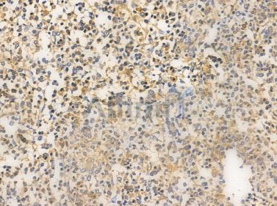 SKP2/p45 Antibody - AF0505 at 1/100 staining human Hodgkin lymphoma by IHC-P.