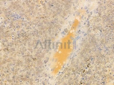 DNA-PK Antibody - AF0550 at 1/100 staining human melanoma by IHC-P.