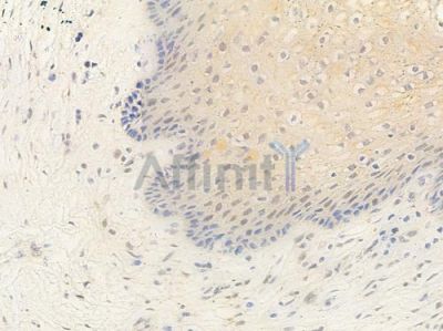 DNA-PK Antibody - AF0550 at 1/100 staining human cervical carcinoma by IHC-P.