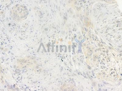 DNA-PK Antibody - AF0550 at 1/100 staining human tongue carcinoma by IHC-P.