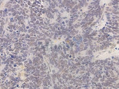 DNA-PK Antibody - AF0550 at 1/100 staining human small cell lung carcinoma by IHC-P.