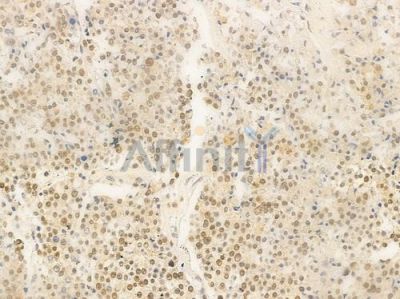 DNA-PK Antibody - AF0550 at 1/100 staining human prostate carcinoma by IHC-P.