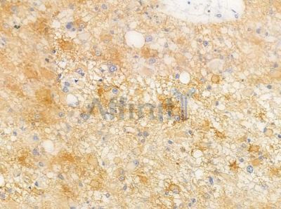 Ephrin A5 Antibody - AF0560 at 1/100 staining human astrocytoma by IHC-P.