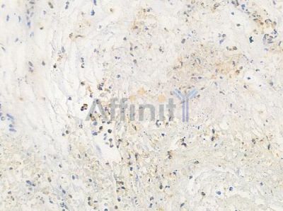 MRC2 Antibody - AF0564 at 1/100 staining human breast carcinoma by IHC-P.
