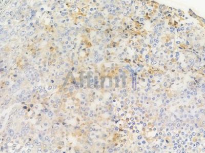 STEAP4 Antibody - AF0574 at 1/100 staining human prostate carcinoma by IHC-P.