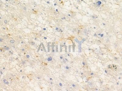 STEAP4 Antibody - AF0574 at 1/100 staining human astrocytoma by IHC-P.