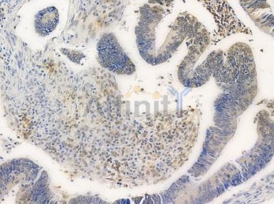 MAGE 1 Antibody - AF0581 at 1/100 staining human colon carcinoma by IHC-P.