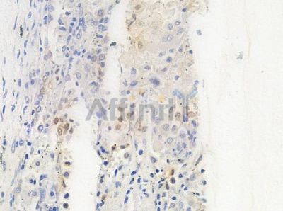 MAGE 1 Antibody - AF0581 at 1/100 staining human lung squamous cell carcinoma by IHC-P.