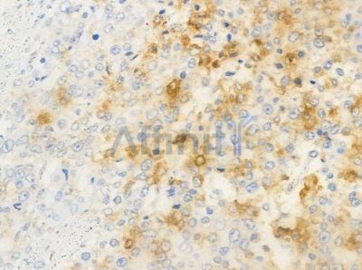 NRIP2 Antibody - AF0597 at 1/100 staining human prostate carcinoma by IHC-P.