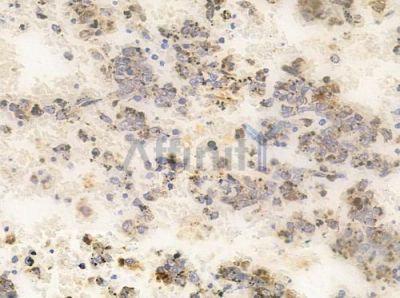 UBXD5 Antibody - AF0606 at 1/100 staining human melanoma by IHC-P.