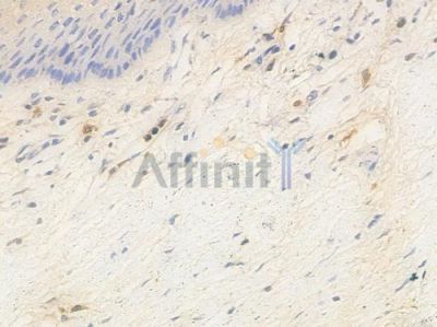 p18 INK4c Antibody - AF0620 at 1/100 staining human cervical carcinoma by IHC-P.