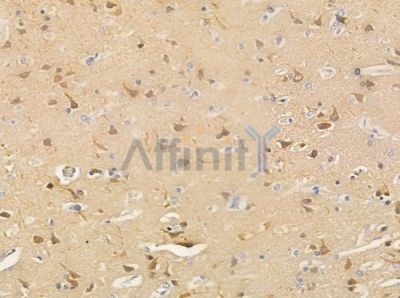 TNAP2 Antibody - AF0630 at 1/100 staining human glioblastoma by IHC-P.