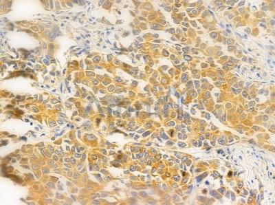FAKD1 Antibody - AF0632 at 1/100 staining human lung squamous cell carcinoma by IHC-P.