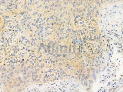 FAKD1 Antibody - AF0632 at 1/100 staining human cervical carcinoma by IHC-P.