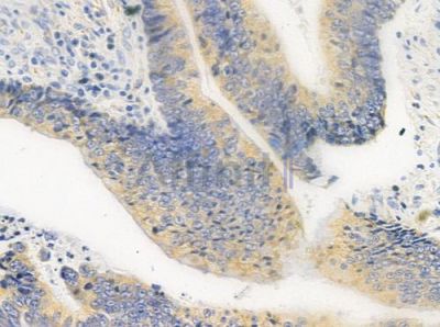 FAKD1 Antibody - AF0632 at 1/100 staining human colon carcinoma by IHC-P.