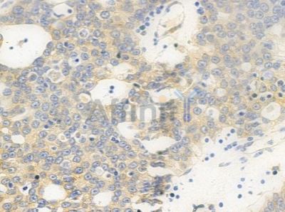 FAKD1 Antibody - AF0632 at 1/100 staining human ovarian carcinoma by IHC-P.