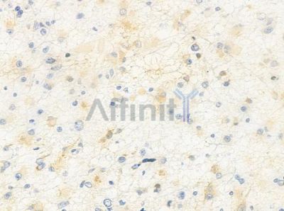 HOXD12 Antibody - AF0644 at 1/100 staining human astrocytoma by IHC-P.