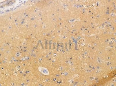 TM16G Antibody - AF0648 at 1/100 staining human glioblastoma by IHC-P.