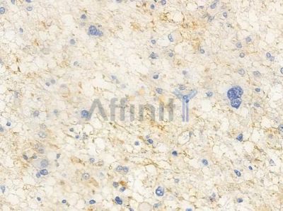 TM16G Antibody - AF0648 at 1/100 staining human astrocytoma by IHC-P.