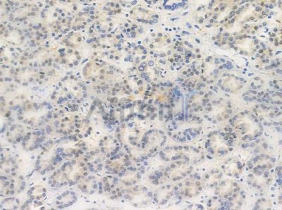 KAT3B / p300 Antibody - AF0674 at 1/100 staining human renal cell carcinoma by IHC-P.