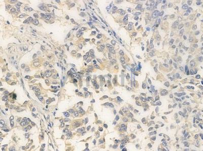 CDKL4 Antibody - AF0675 at 1/100 staining human lung squamous cell carcinoma by IHC-P.