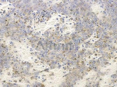 NCK2 Antibody - AF0679 at 1/100 staining human melanoma by IHC-P.