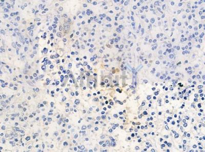 ZNF287 Antibody - AF0684 at 1/100 staining human Hodgkin lymphoma by IHC-P.