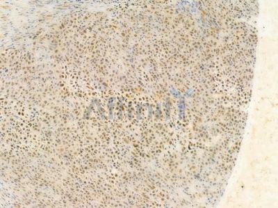 PSMD2 Antibody - AF0707 at 1/100 staining human non-Hodgkin lymphoma by IHC-P.