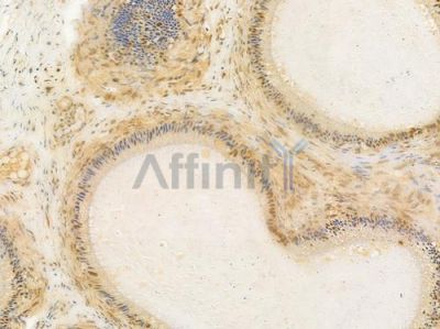 PSMD2 Antibody - AF0707 at 1/100 staining human testicular cancer by IHC-P.