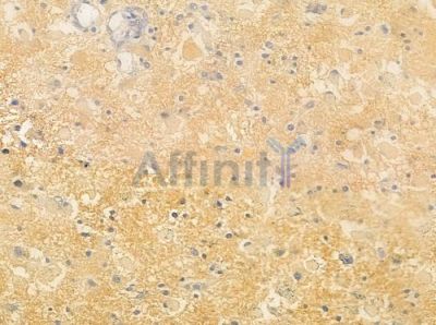 GASP1 Antibody - AF0712 at 1/100 staining human astrocytoma by IHC-P.