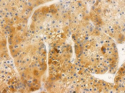 RBP5 Antibody - AF0720 at 1/100 staining human hepatocellular carcinoma by IHC-P.