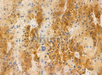 RBP5 Antibody - AF0720 at 1/100 staining human hepatocellular carcinoma by IHC-P.